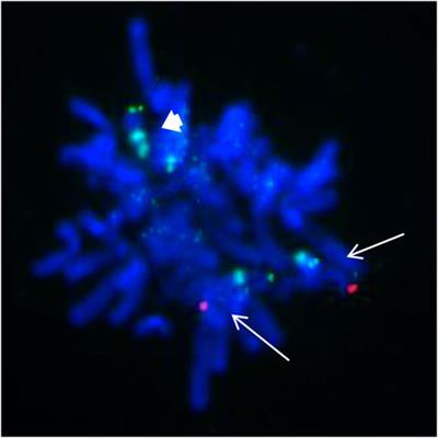 Case Report: Prenatal diagnosis of fetal tetrasomy 9p initially identified by non-invasive prenatal testing